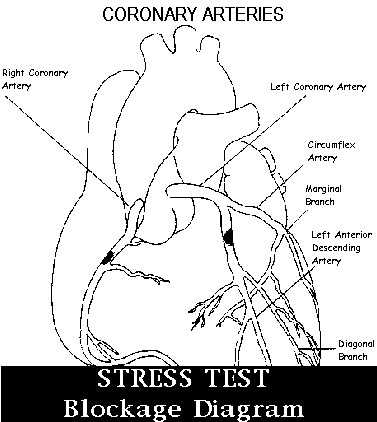 Picture of the artery blockage